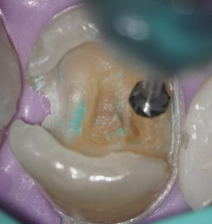 今日のう蝕治療｜神戸三宮の歯医者｜高田歯科は、虫歯治療を得意としています。